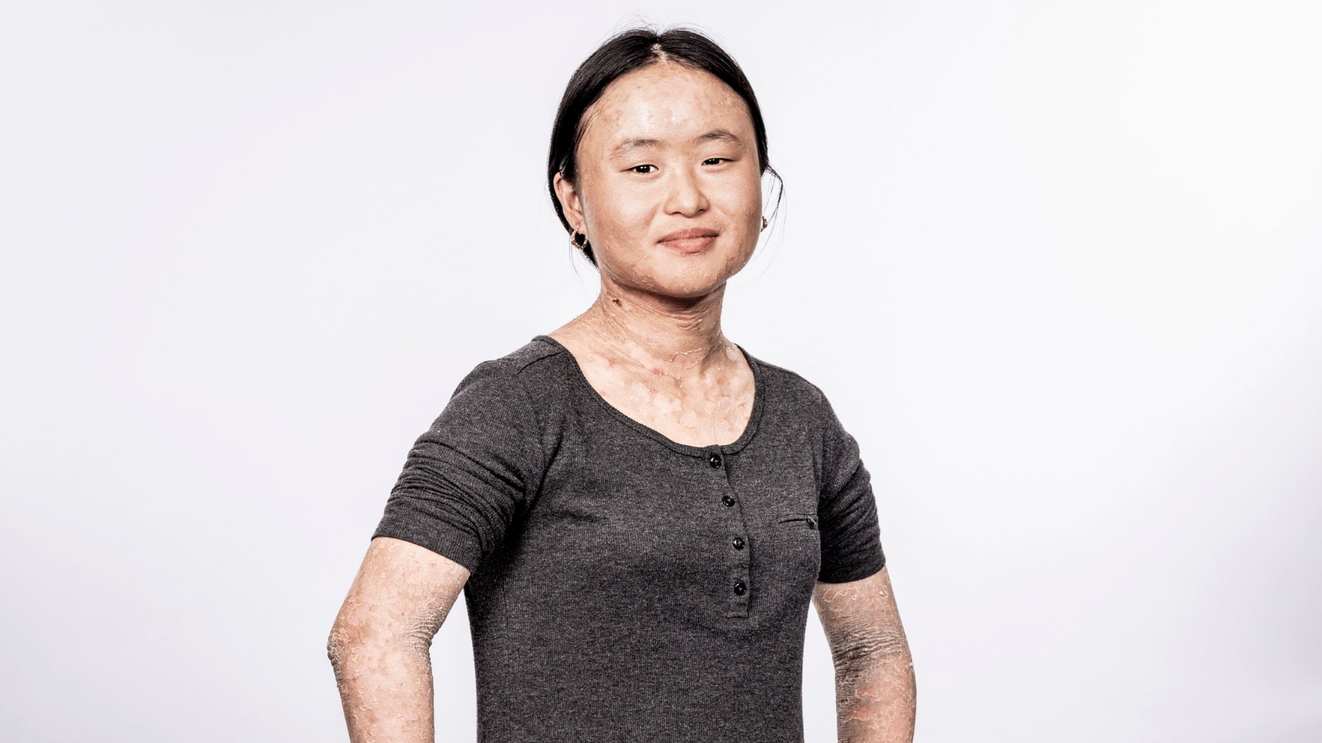 Anna, who has ichthyosis, smiling at the camera