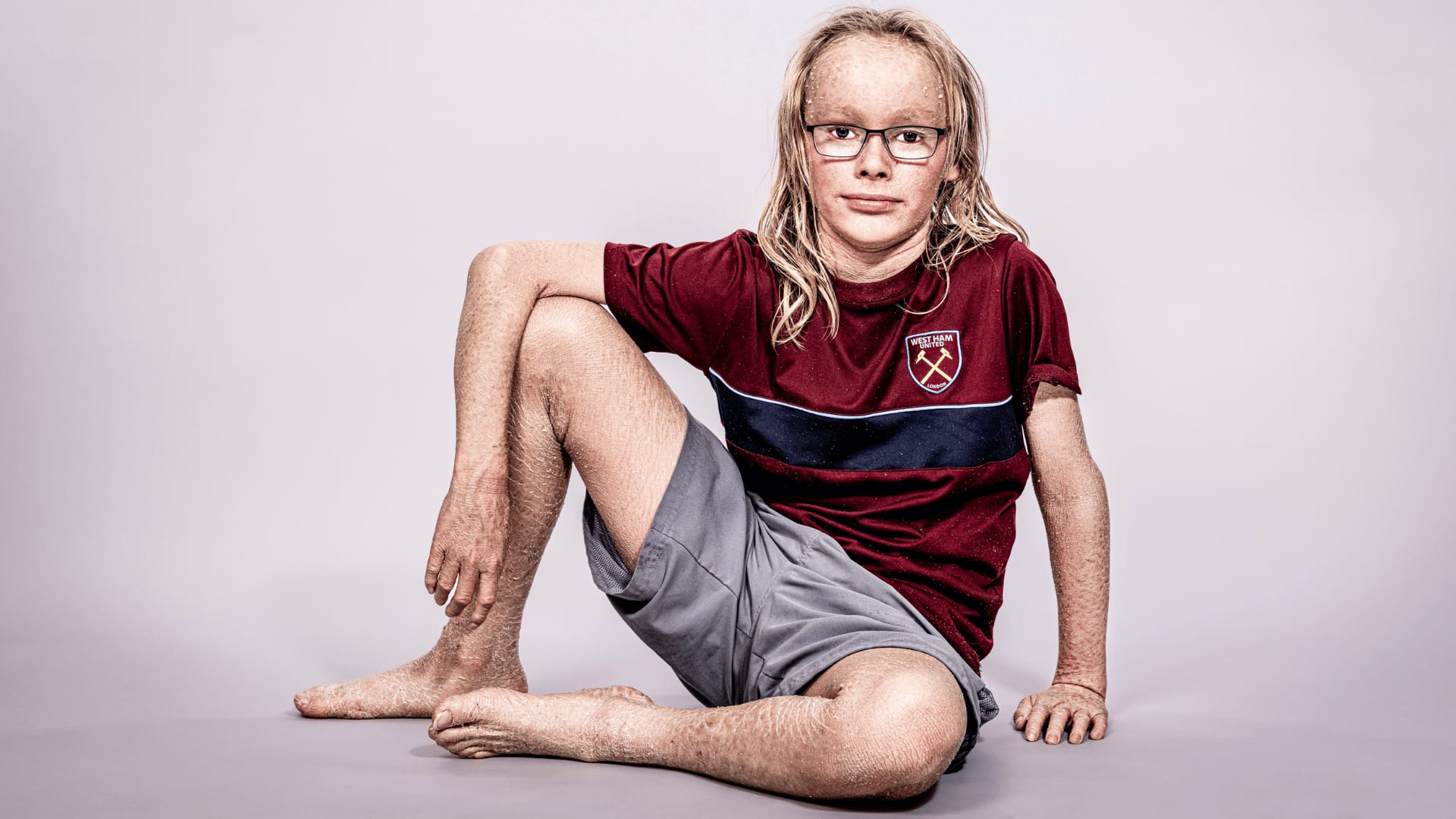 Faces of Ichthyosis: Daniel