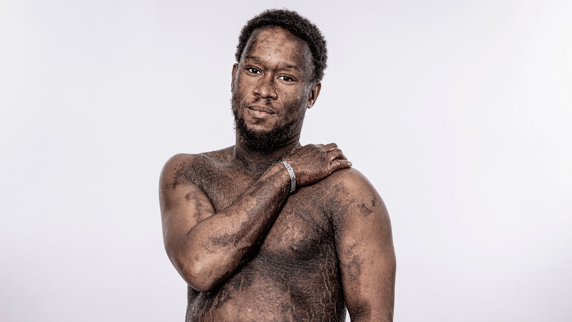 Faces of Ichthyosis: Elliot