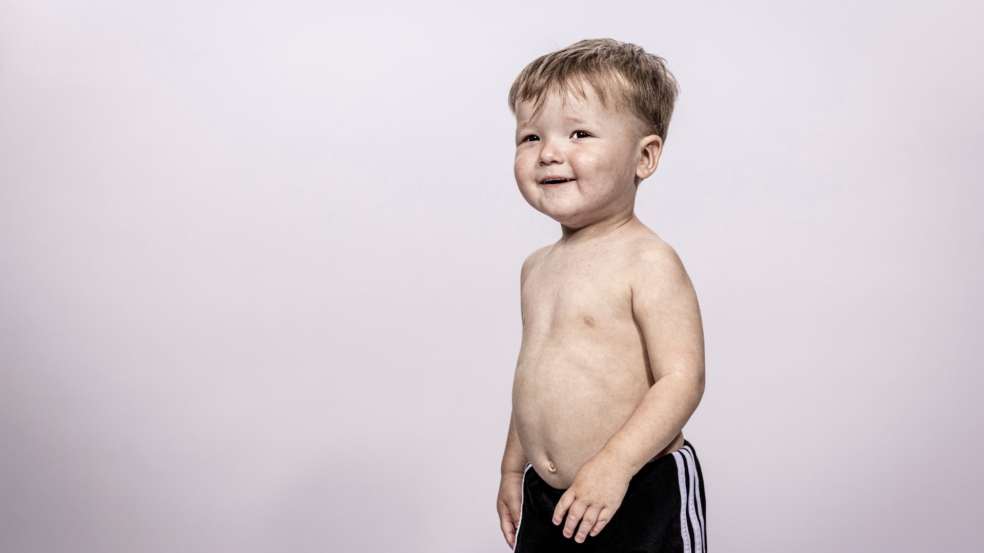 Faces of Ichthyosis: Henry