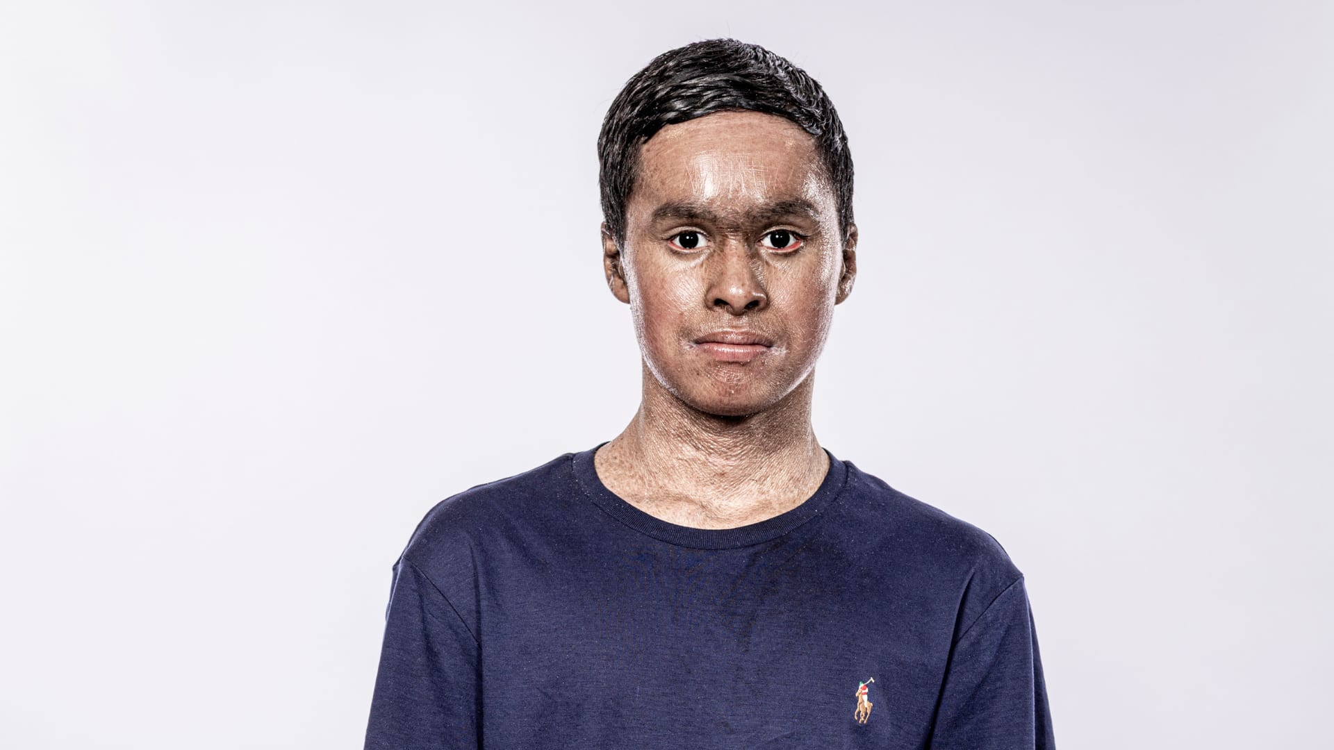 Faces of Ichthyosis: Ibrahim