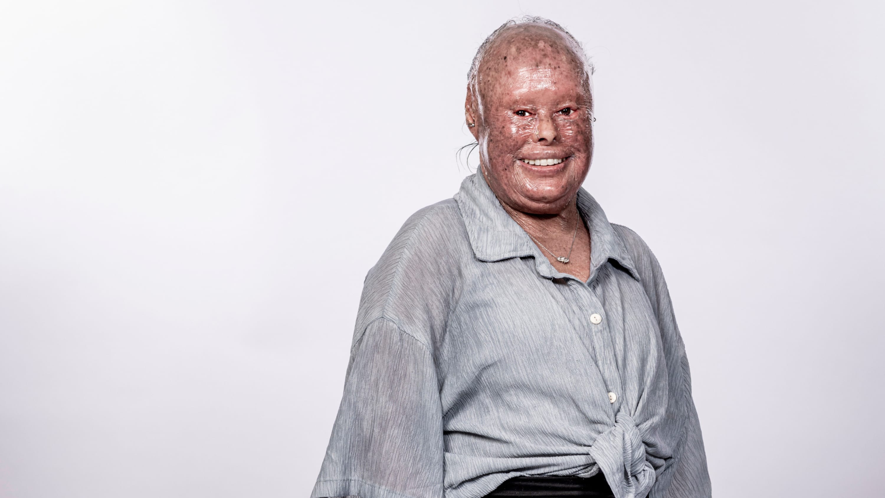 Faces of Ichthyosis: Nelly