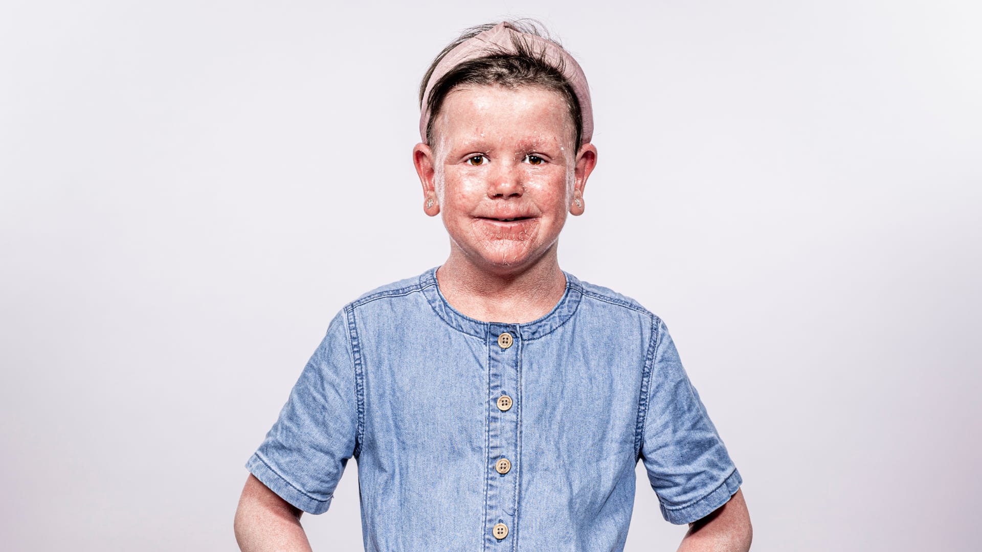 Robyn, a young girl with ichthyosis